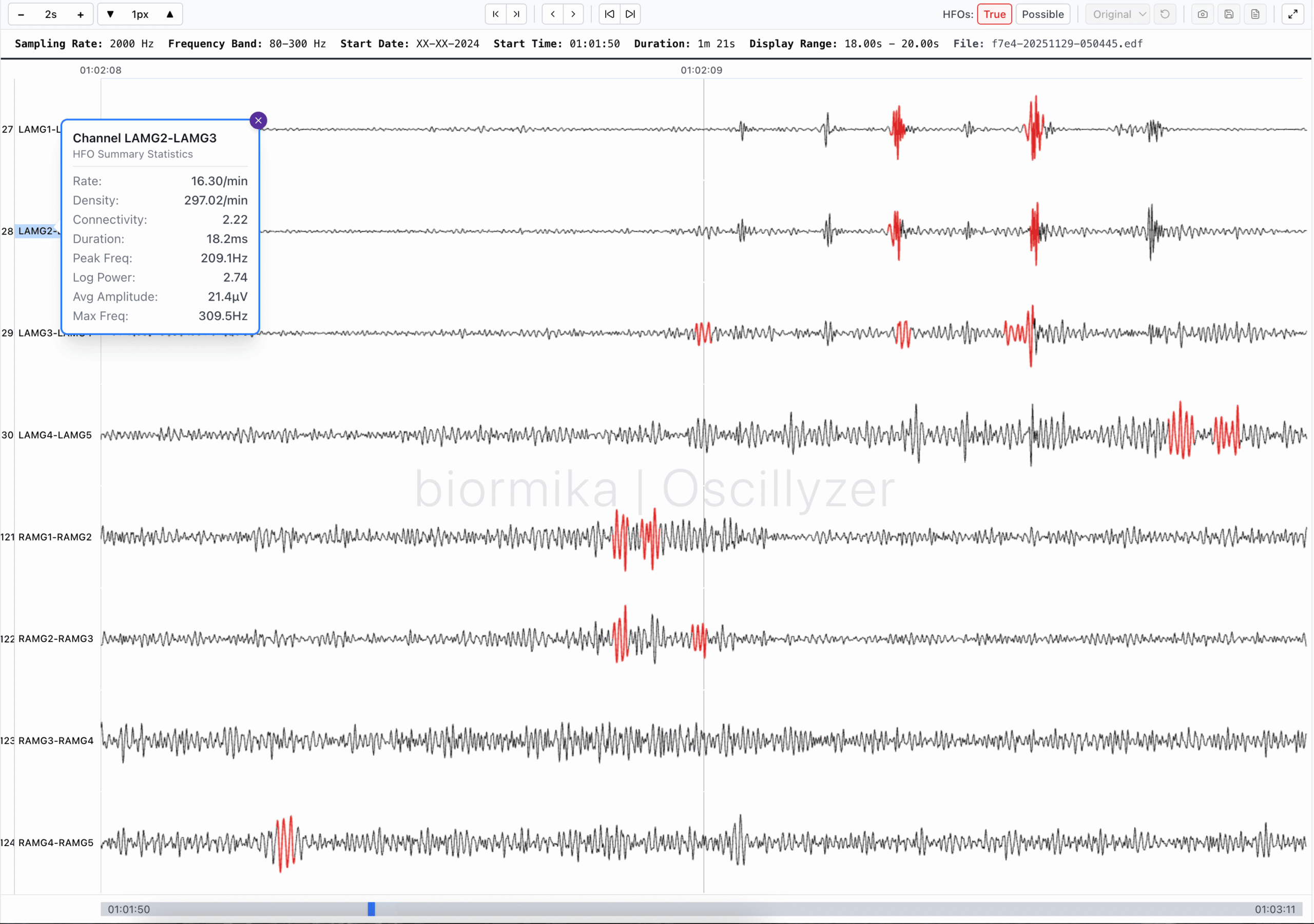 Oscillyzer tool by Biormika for high-frequency oscillation (HFO) detection in epilepsy research